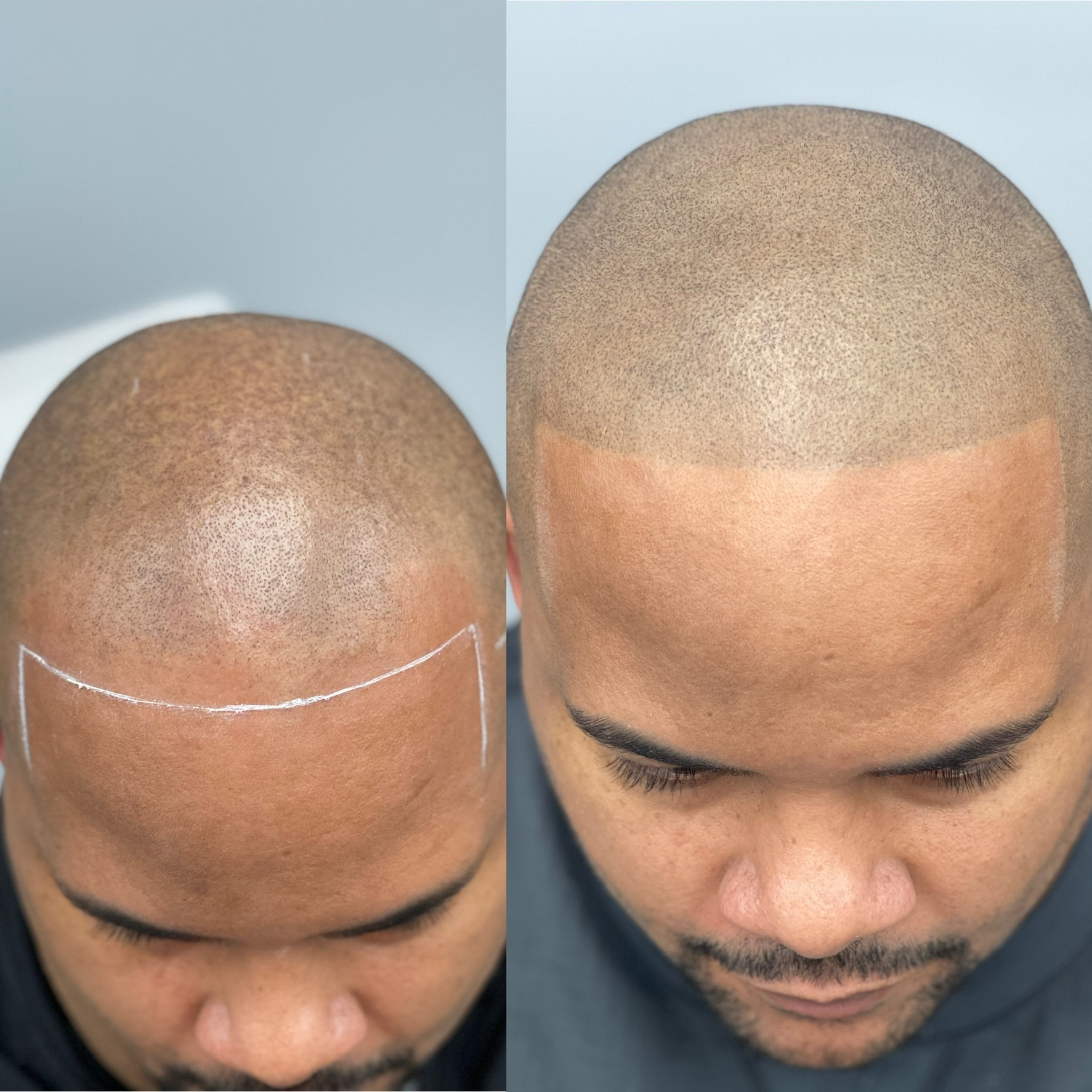 Scalp Micropigmentation Florida